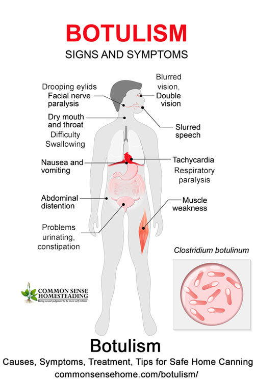 Botulism (Clostridium Botulinum) Sickness - Causes, symptoms of botulism toxin poisoning, treatment, how to prevent botulism in home canned foods.